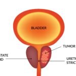 Prostate Cancer