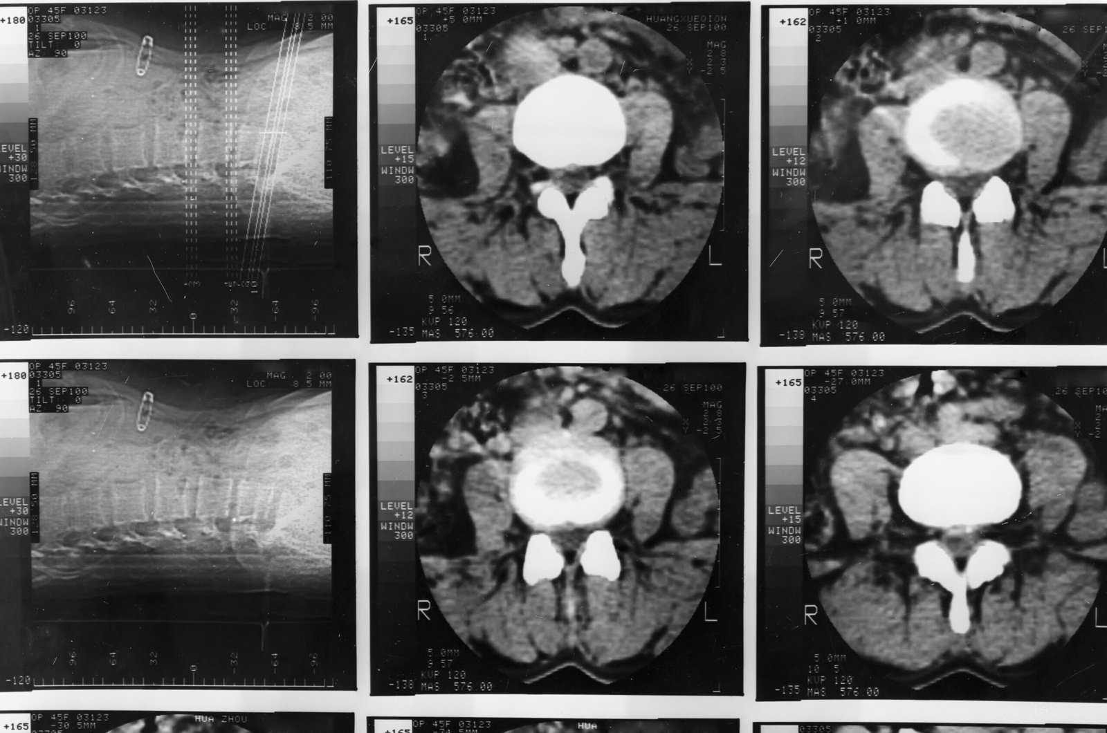 A medical scan shows two x-ray images of the lumbar spine on the left and four CT cross-section images of the lower abdomen and spine on the right, presented in a grid format, possibly indicating findings related to metastatic prostate cancer.