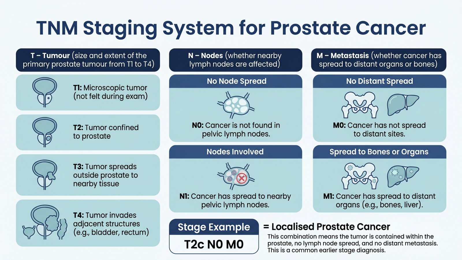 Infographic illustrating the TNM staging system for prostate cancer, detailing tumour size (T), lymph node involvement (N), and metastasis (M) with clear diagrams and an example stage: T2c N0 M0.