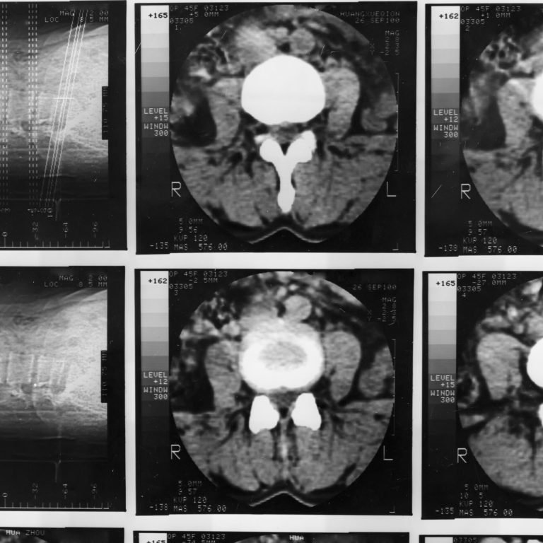 A medical scan shows two x-ray images of the lumbar spine on the left and four CT cross-section images of the lower abdomen and spine on the right, presented in a grid format, possibly indicating findings related to metastatic prostate cancer.